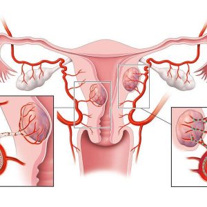 Tumore dellendometrio 300x300 EKfxSl